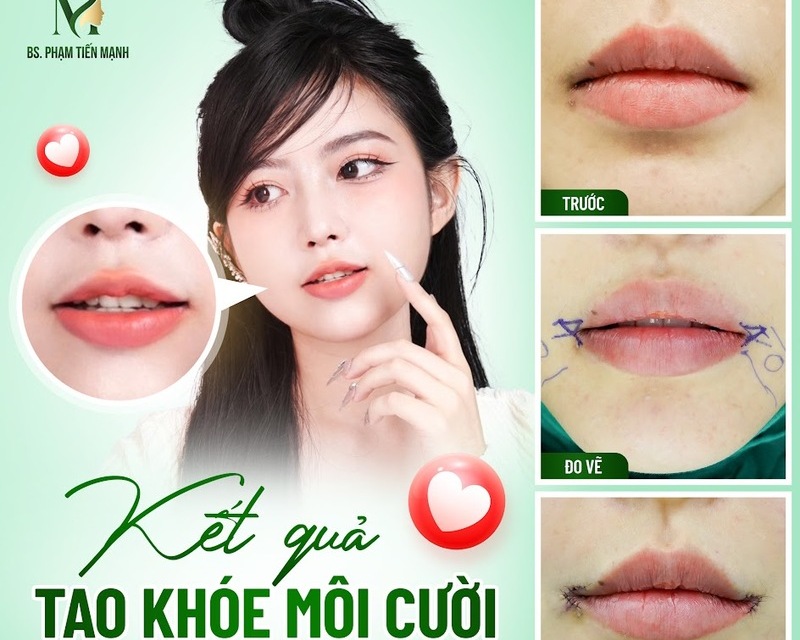 Làm khoé miệng cười tại Thẩm mỹ MD Change Life (Nguồn: MD Change Life)