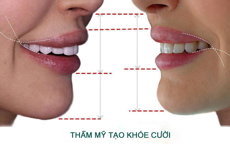 Cách có khóe miệng cười rạng rỡ, tươi tắn