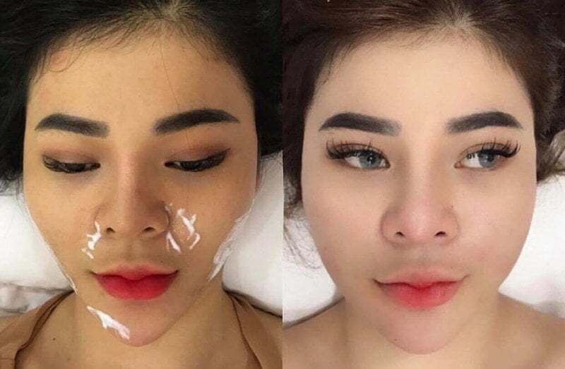 Tiêm filler - Cách tạo khoé môi là phương pháp phổ biến nhất (Nguồn: Internet)