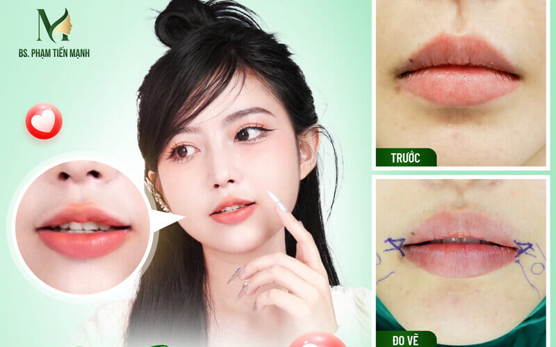 Cách tiêm tạo khoé môi xinh