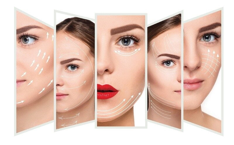 Các vị trí căng chỉ trẻ hoá gương mặt phổ biến (Nguồn: Internet)
