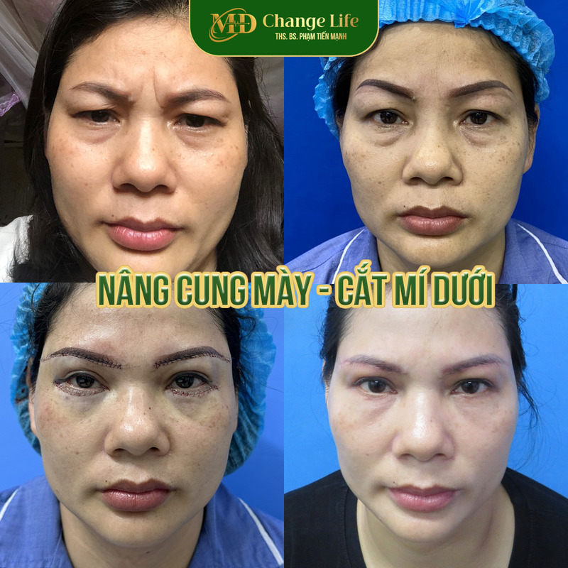 Kết quả căng chỉ trẻ hóa mắt Nghệ An tại Thẩm mỹ MD Change Life (Nguồn: Thẩm mỹ MD Change Life)