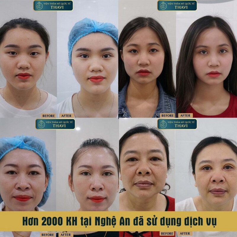 Dịch vụ căng chỉ trẻ hóa mắt Nghệ An tại Viện Thẩm mỹ Quốc tế Thavi (Nguồn: Viện Thẩm mỹ Quốc tế Thavi)