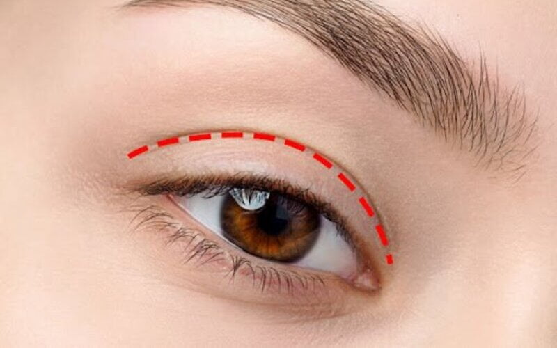 Cắt mí là tiểu phẫu tạo ra một nếp gấp chính là mí mắt mới đối với mí mắt trên (Nguồn: Internet)
