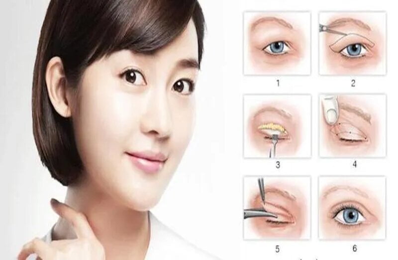 Cắt mí mắt là phương pháp làm đẹp phổ biến (Nguồn: Internet)