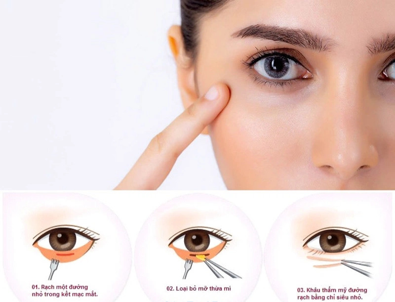 5 Địa Chỉ Cắt Mí Dưới Hà Nội Uy Tín Nhất