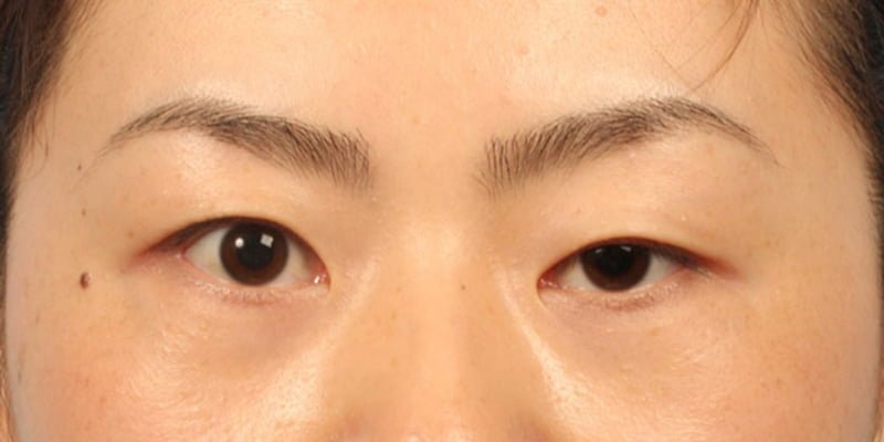 Chỉnh hình sụp mí giúp giải quyết tình trạng mí mắt bị sụp xuống, che khuất một phần hoặc toàn bộ đồng tử (Nguồn: Internet)