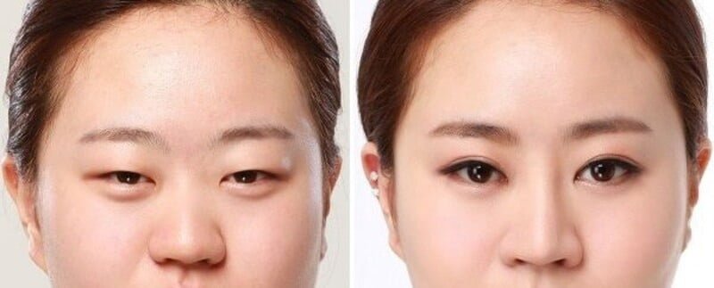 Phẫu thuật chỉnh hình sụp mí khắc phục tình trạng sụp mí, nâng cao mí mắt bị sụp xuống (Nguồn: Internet)