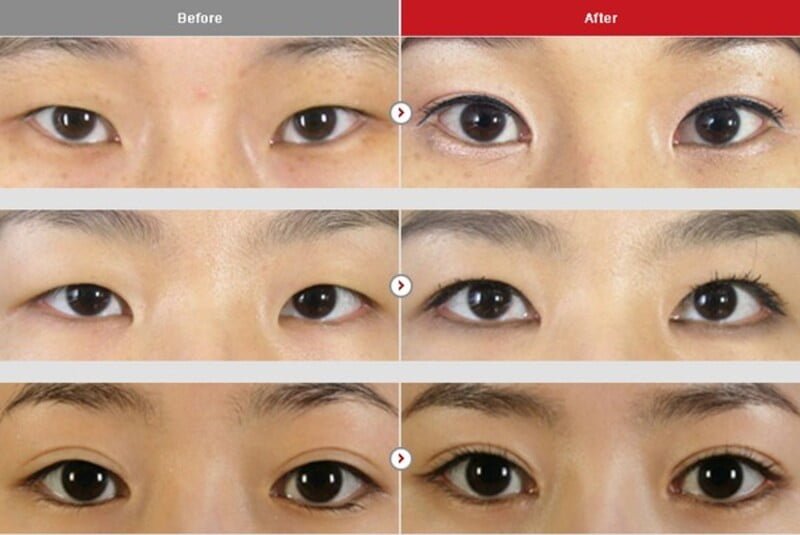 Chỉnh hình sụp mí giúp bạn sở hữu đôi mắt đẹp tự nhiên, rạng rỡ với nhiều ưu điểm vượt trội (Nguồn: Internet)