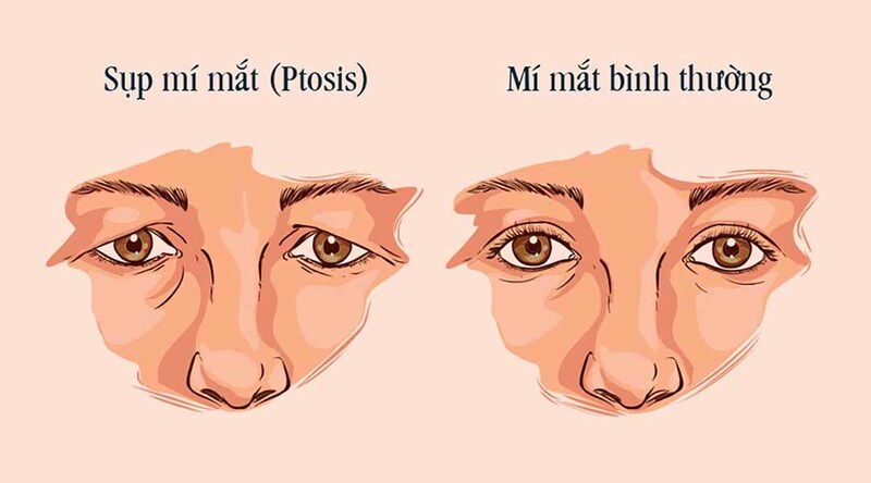 Top 6 Địa Chỉ Chỉnh Hình Sụp Mí Hà Nội