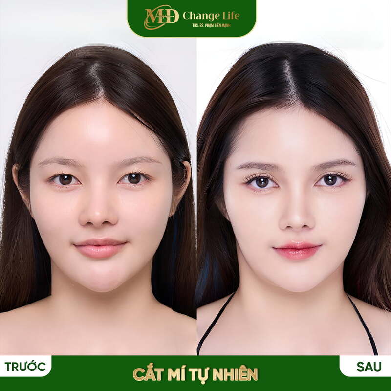 Chữa sụp mí – Đôi mắt tươi trẻ, thần thái hơn