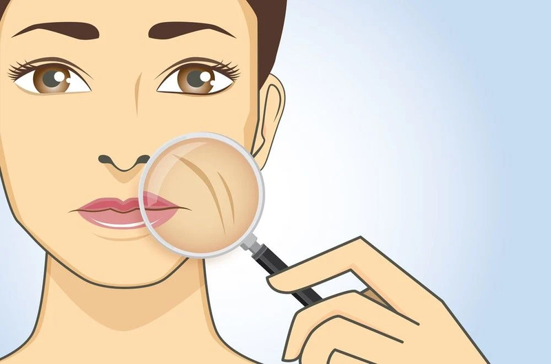 Khoé cười sâu: Nguyên nhân, cách khắc phục hiệu quả