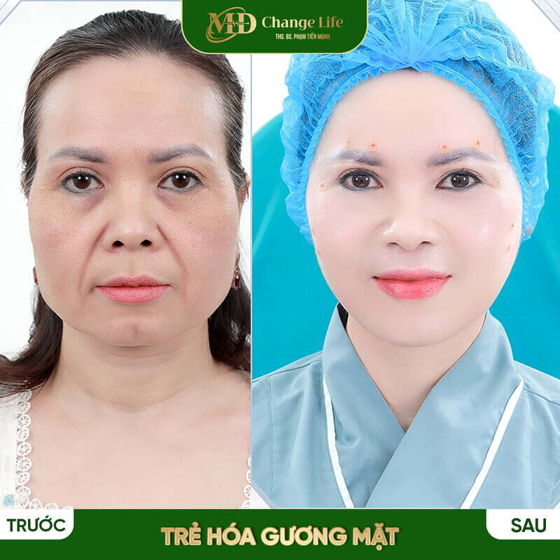 Khoé cười sâu: Nguyên nhân, cách khắc phục hiệu quả
