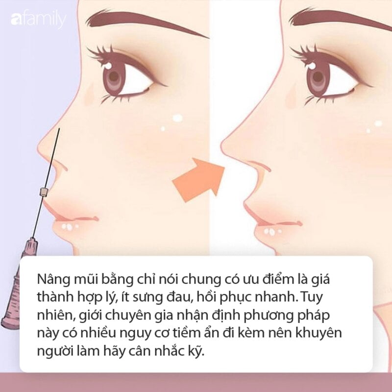 Phương pháp nâng mũi này có rất nhiều ưu điểm (Nguồn: Internet)