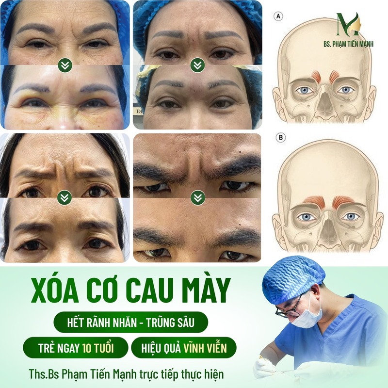Lợi ích của xóa cơ cau mày (Nguồn:Thẩm Mỹ MD Change Life)
