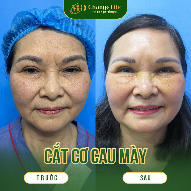 Khách hàng sau khi hồi phục phẫu thuật xóa cơ cau mày (Nguồn:Thẩm Mỹ MD Change Life)