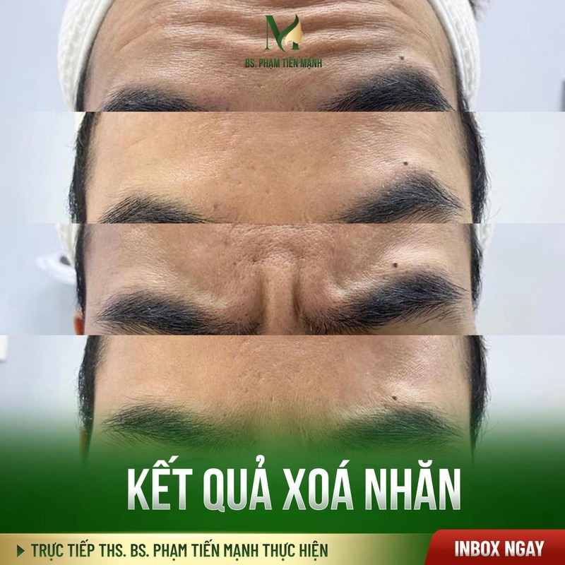 Khách hàng sau xóa nhăn cau mày tại MD Change Life (Nguồn:Thẩm Mỹ MD Change Life)