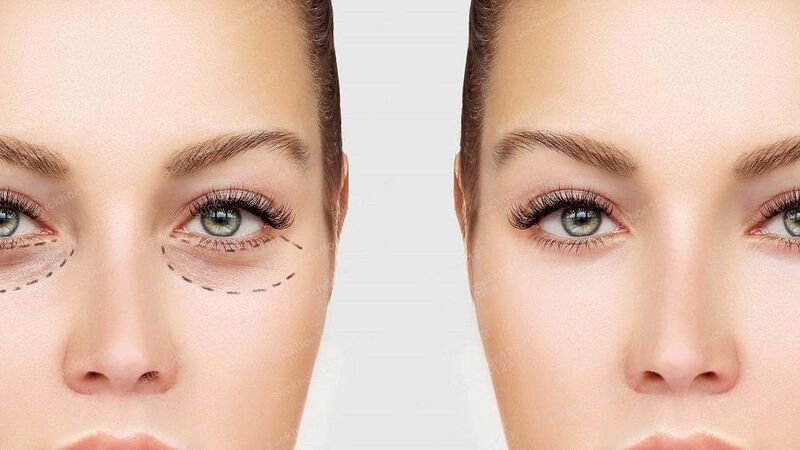 Những người có bọng mỡ rõ rệt dưới mắt khiến khuôn mặt trông mệt mỏi và già nua là ứng viên tốt cho cắt mí dưới (Nguồn: Internet)