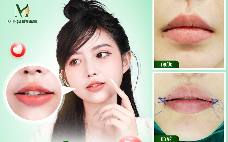 Tạo khóe môi cười rạng rỡ tại Thẩm Mỹ MD Change Life (Nguồn: Thẩm Mỹ MD Change Life)