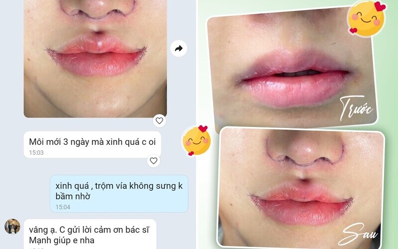 Top 5 địa chỉ thu ngắn nhân trung tại Nghệ An