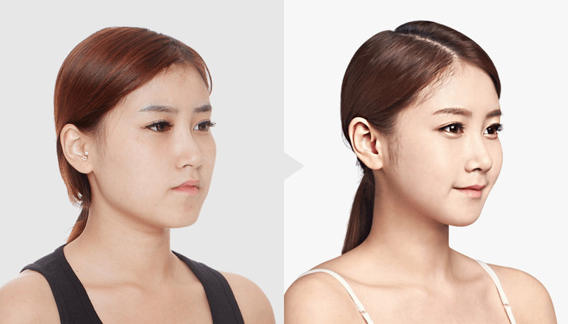 Tiêm botox thon gọn mặt tại Thẩm Mỹ MD Change Life (Nguồn: MD Change Life)