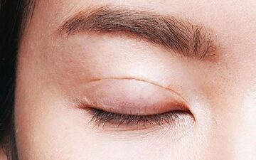Cắt mí kiêng ăn gì? Ăn uống sao để mau lành, không sẹo!