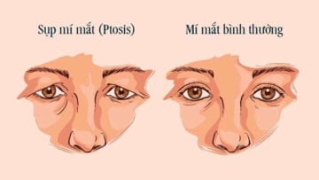 Sụp mí mắt là gì? (Nguồn: Internet)