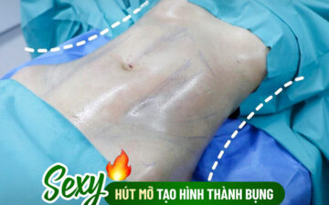 6 địa chỉ hút mỡ body Hà Nội uy tín