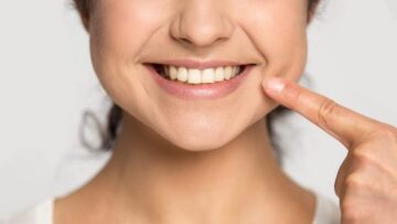 Khoé cười sâu: Nguyên nhân, cách khắc phục hiệu quả