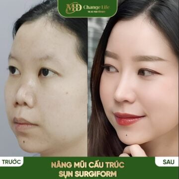 Feedback của khách hàng sau khi nâng mũi cấu trúc tại Thẩm mỹ MD Change Life (Nguồn: MD Change Life)