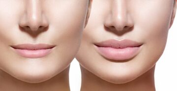 Tiêm filler môi mũi cằm là gì? (Nguồn: Internet)